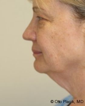 Neck Lift - Before & After - Dr. Placik