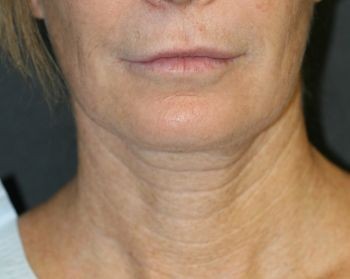 Neck Lift - Before & After - Dr. Placik