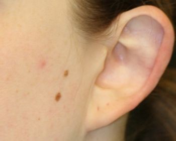 Ear Surgery - Before & After - Dr. Placik