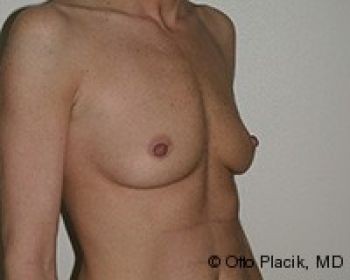 Breast Augmentation Chicago