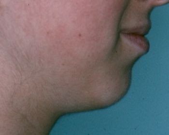 Chin Surgery - Before & After - Dr. Placik