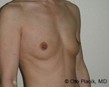 Breast Augmentation Chicago