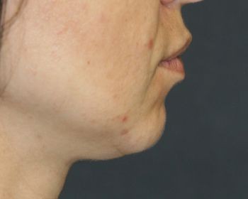 Kybella - Before & After - Dr. Placik