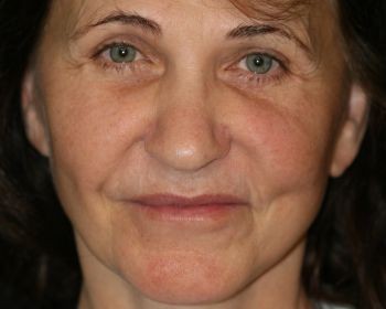 Lipoinjections to Various Facial Areas - Before & After - Dr. Placik