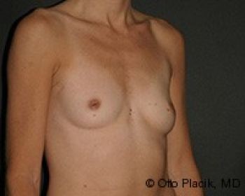 Breast Augmentation