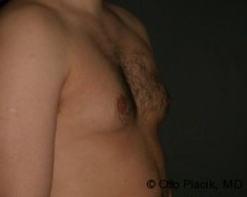 Male Breast Reduction - Before & After - Dr. Placik