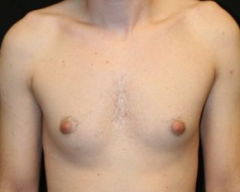 Male Breast Reduction - Before & After - Dr. Placik