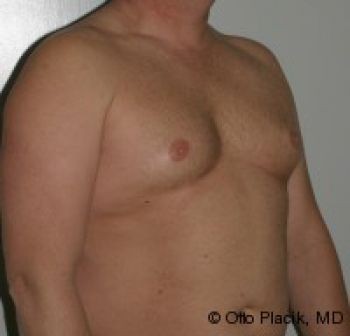 Male Breast Reduction - Before & After - Dr. Placik