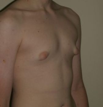 Male Breast Reduction - Before & After - Dr. Placik