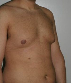 Male Breast Reduction - Before & After - Dr. Placik