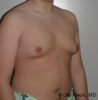 Male Breast Reduction - Before & After - Dr. Placik