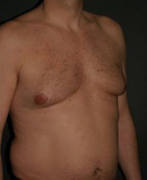 Male Breast Reduction - Before & After - Dr. Placik