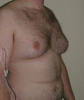 Male Breast Reduction