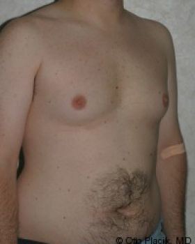 Male Breast Reduction