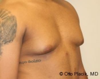 Male Breast Reduction - Before & After - Dr. Placik