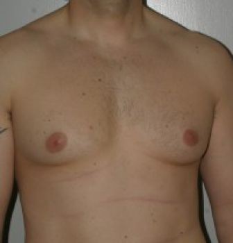 Male Breast Reduction Chicago