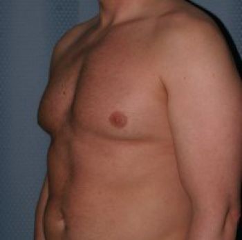 Male Breast Reduction