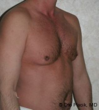 Male Breast Reduction