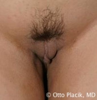 Labiaplasty Chicago