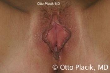 Labiaplasty - Dr. Placik - Chicago