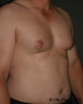 Male Breast Reduction Chicago