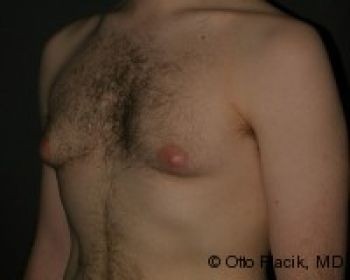 Male Breast Reduction Chicago