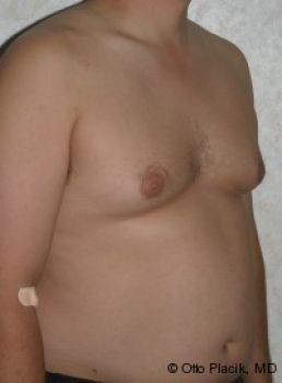 Male Breast Reduction Chicago