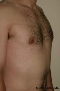 Male Breast Reduction