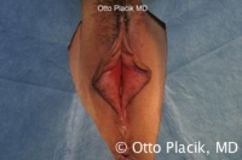 Labiaplasty - Dr. Placik - Chicago