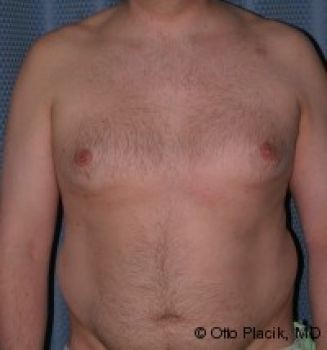 Male Breast Reduction Chicago