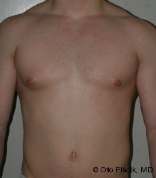 Male Breast Reduction