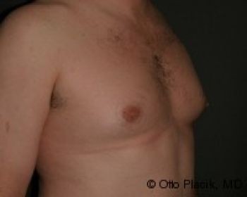 Male Breast Reduction Chicago