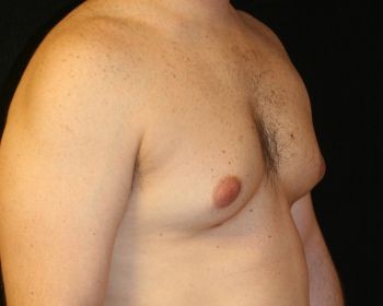 Male Breast Reduction Chicago