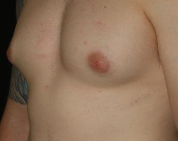 Male Breast Reduction