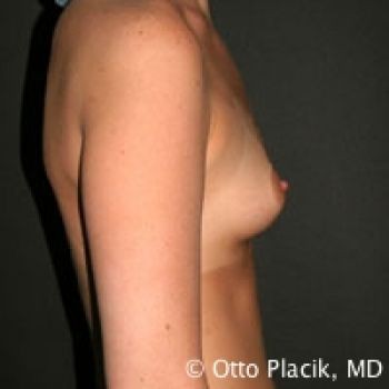 Breast Augmentation