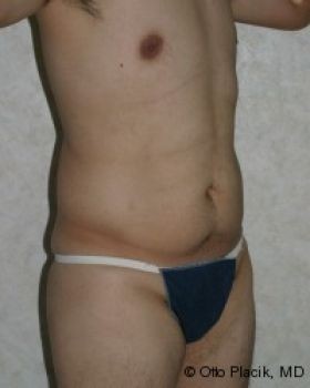 Male Liposuction Chicago