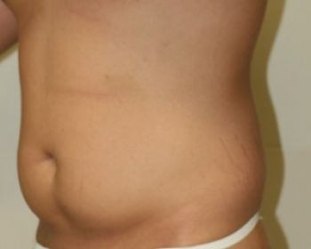 Male Liposuction in Chicago