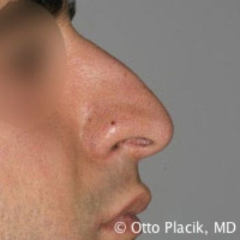 Male Rhinoplasty - Before & After - Dr. Placik