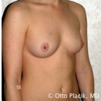 Breast Augmentation