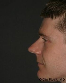 Male Rhinoplasty