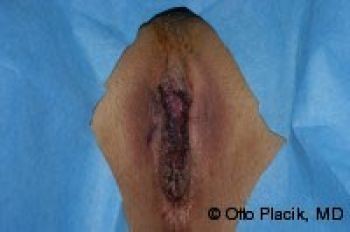 Labiaplasty