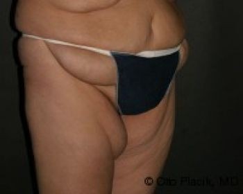 Mons Pubis Reduction Utilizing Liposuction Chicago