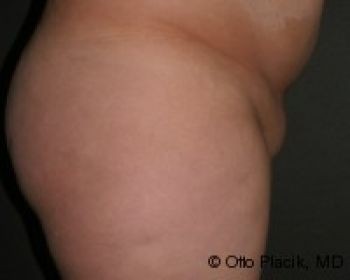 Mons Pubis Reduction Utilizing Liposuction