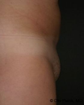 Mons Pubis Reduction - Before & After - Dr. Placik