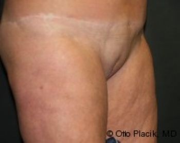 Mons Pubis Reduction - Before & After - Dr. Placik