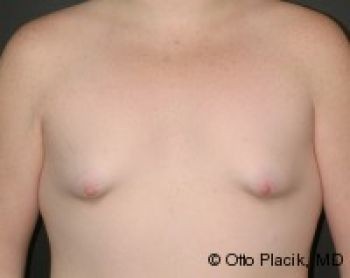 Before & After Breast Augmentation Gallery - Before & After - Dr. Placik