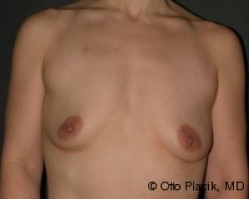 Before & After Breast Augmentation Gallery - Before & After - Dr. Placik