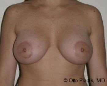 Before & After Breast Augmentation Gallery - Before & After - Dr. Placik