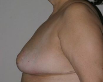 Breast Reduction Chicago