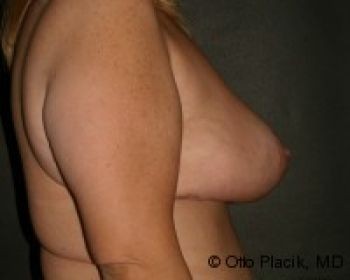 Breast Reduction Chicago